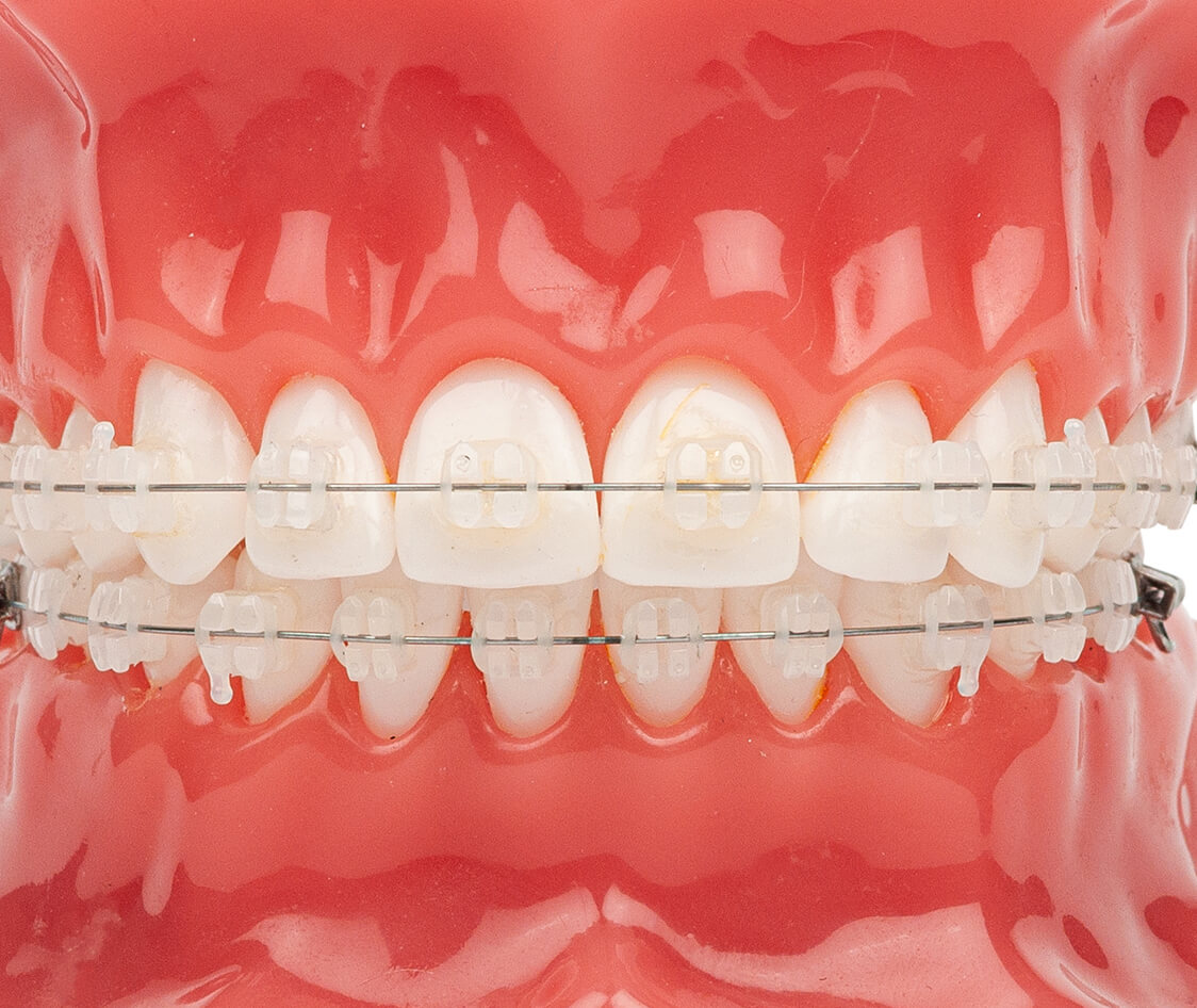 Orthodontic model demonstration teeth model of orthodontic bracket or brace. Ceramic braces on teeth on an artificial jaws closeup