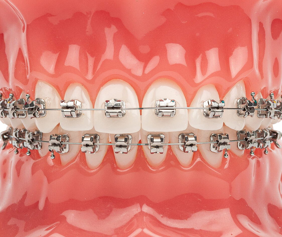 Orthodontic model demonstration teeth model of orthodontic bracket or brace. Metal braces on teeth on an artificial jaws closeup